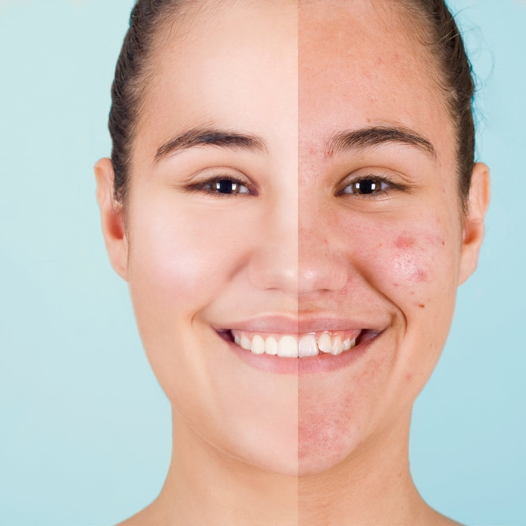 9 DIY Face Packs for Acne-Free Skin