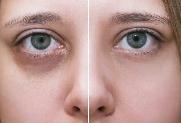 Dark Circles: Causes, Types, and Home Remedies